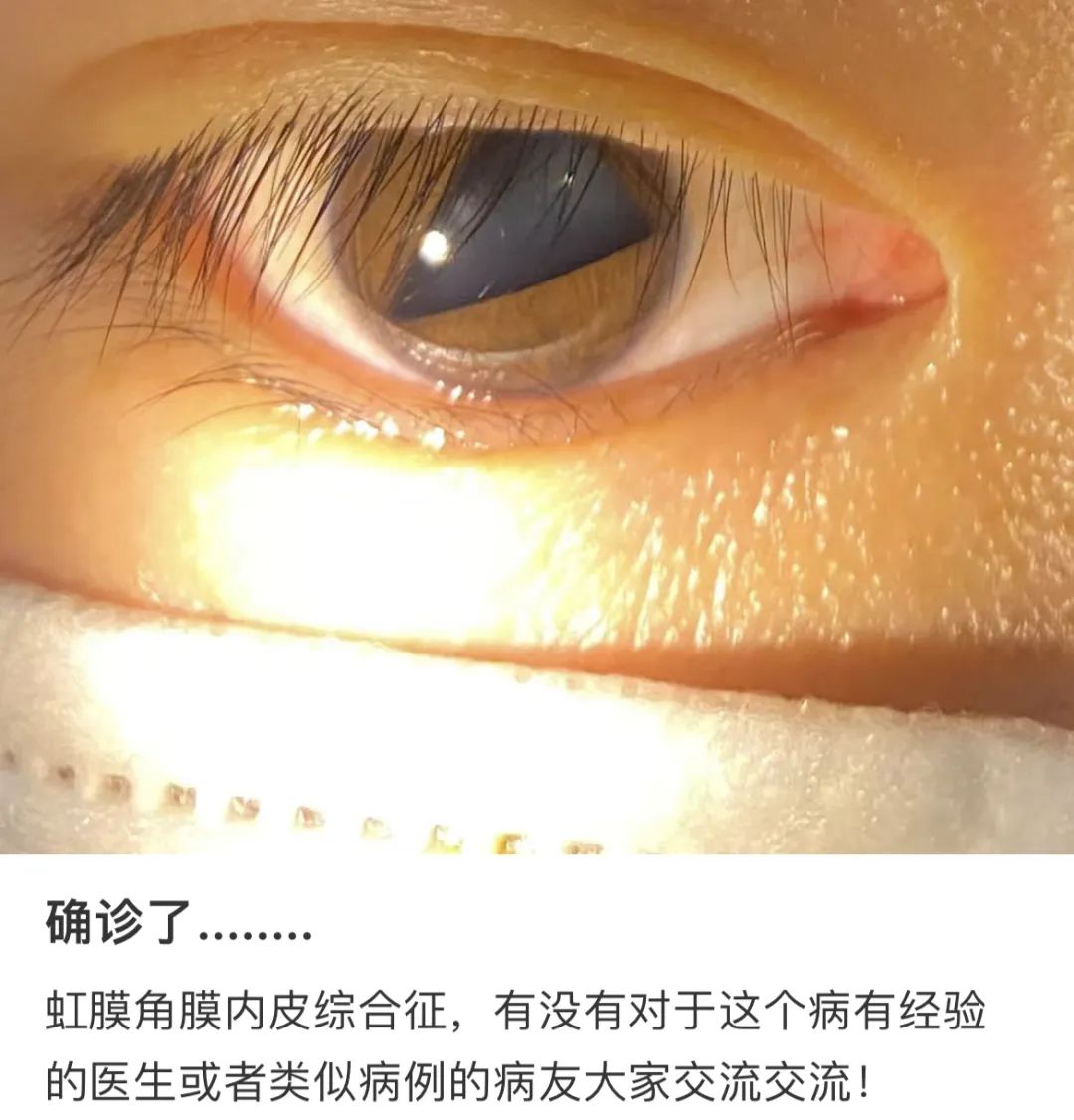 角膜内皮细胞功能及其重要性