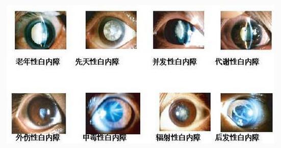 白内障治疗效果及其影响因素分析