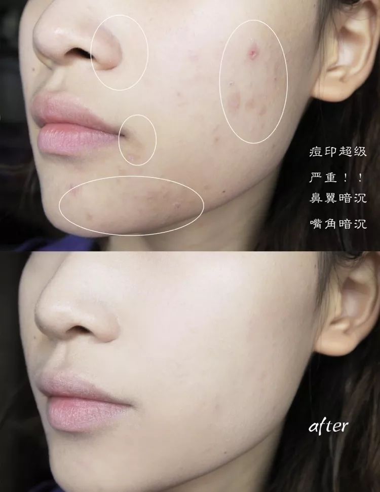 痘印治疗效果，探索与解析