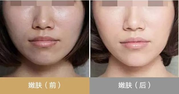 解决鼻子干燥火燎疼痛的有效方法