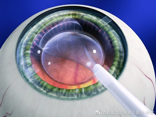 近视手术后用什么眼罩，选择与应用的探讨