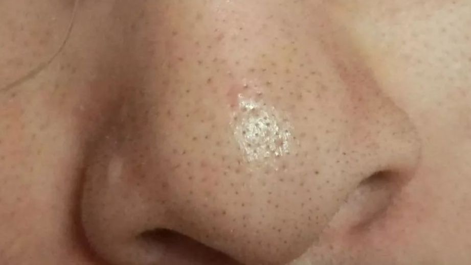 鼻子上有黑头怎么办？全面解析黑头成因与应对之策
