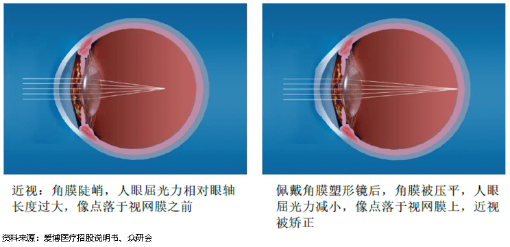 矫正视力新利器，神秘眼罩的潜力与未来展望