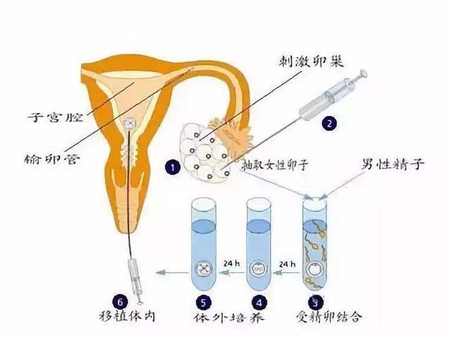 探究取卵过程中止痛针的应用