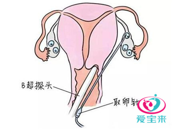 关于试管婴儿技术中的取卵过程，是否需要在取卵前打夜针？
