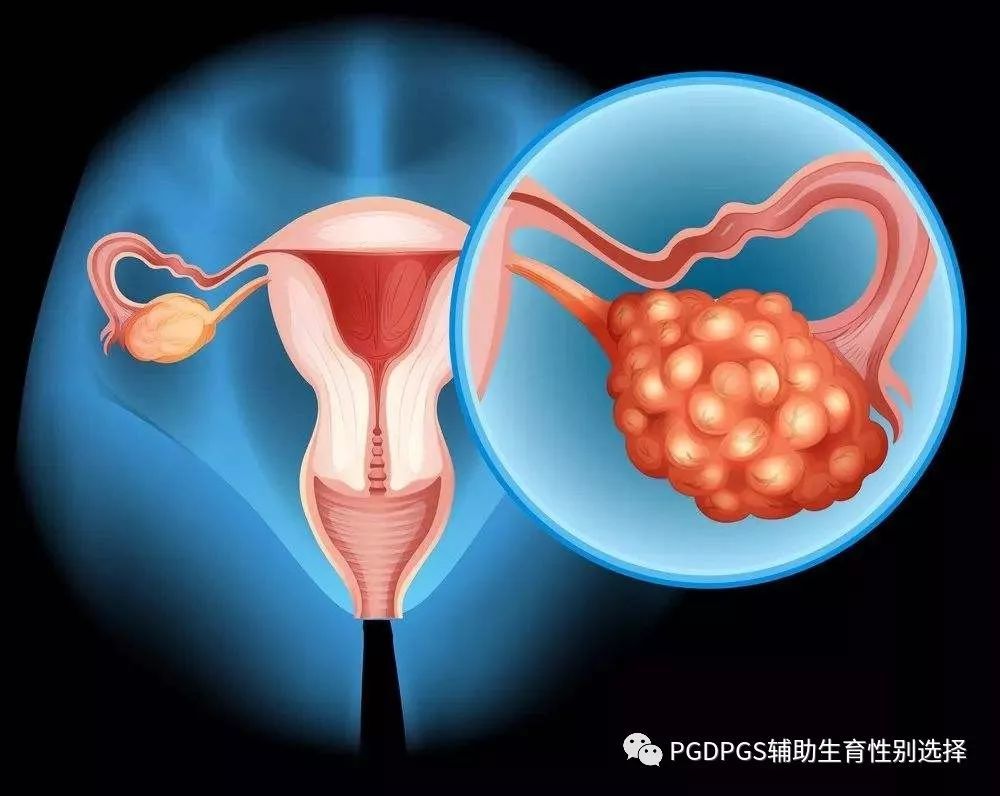 取卵后卵巢保护的重要性及策略